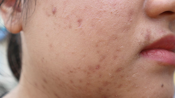 ニキビ・ニキビ痕