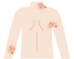 アトピー性皮膚炎