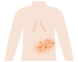 帯状疱疹癬