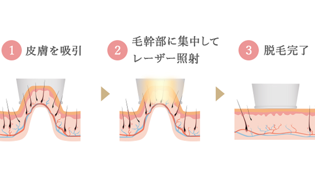 ①皮膚を吸引 ②毛管部に集中してレーザー照射 ③脱毛完了
