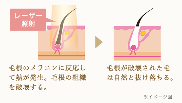 毛根のメラニンに反応して熱が発生。→ 毛根の組織を破壊する。毛根が破壊された毛は自然と抜け落ちる。