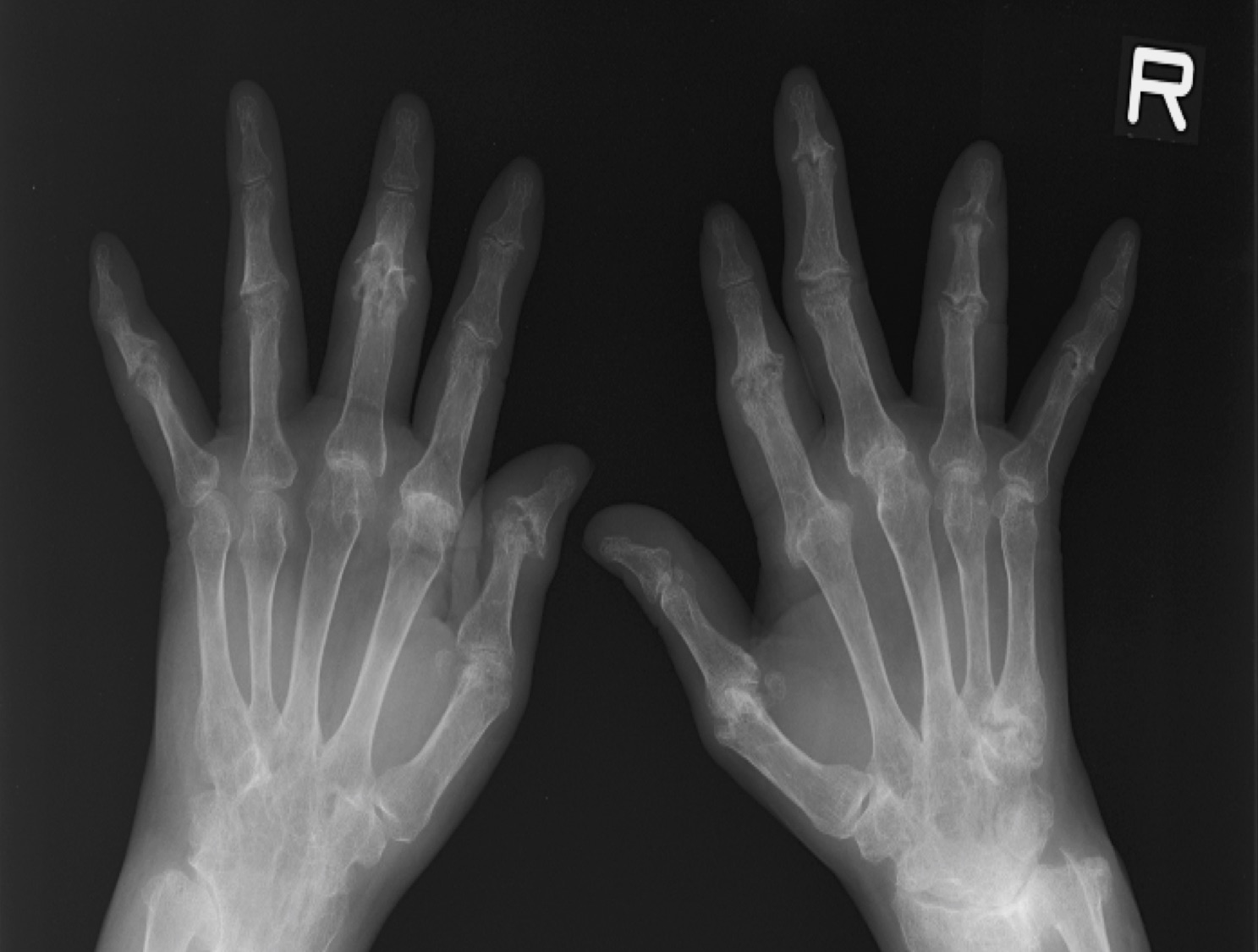 PsA は 1 本の指だけに影響を与える可能性がありますか?