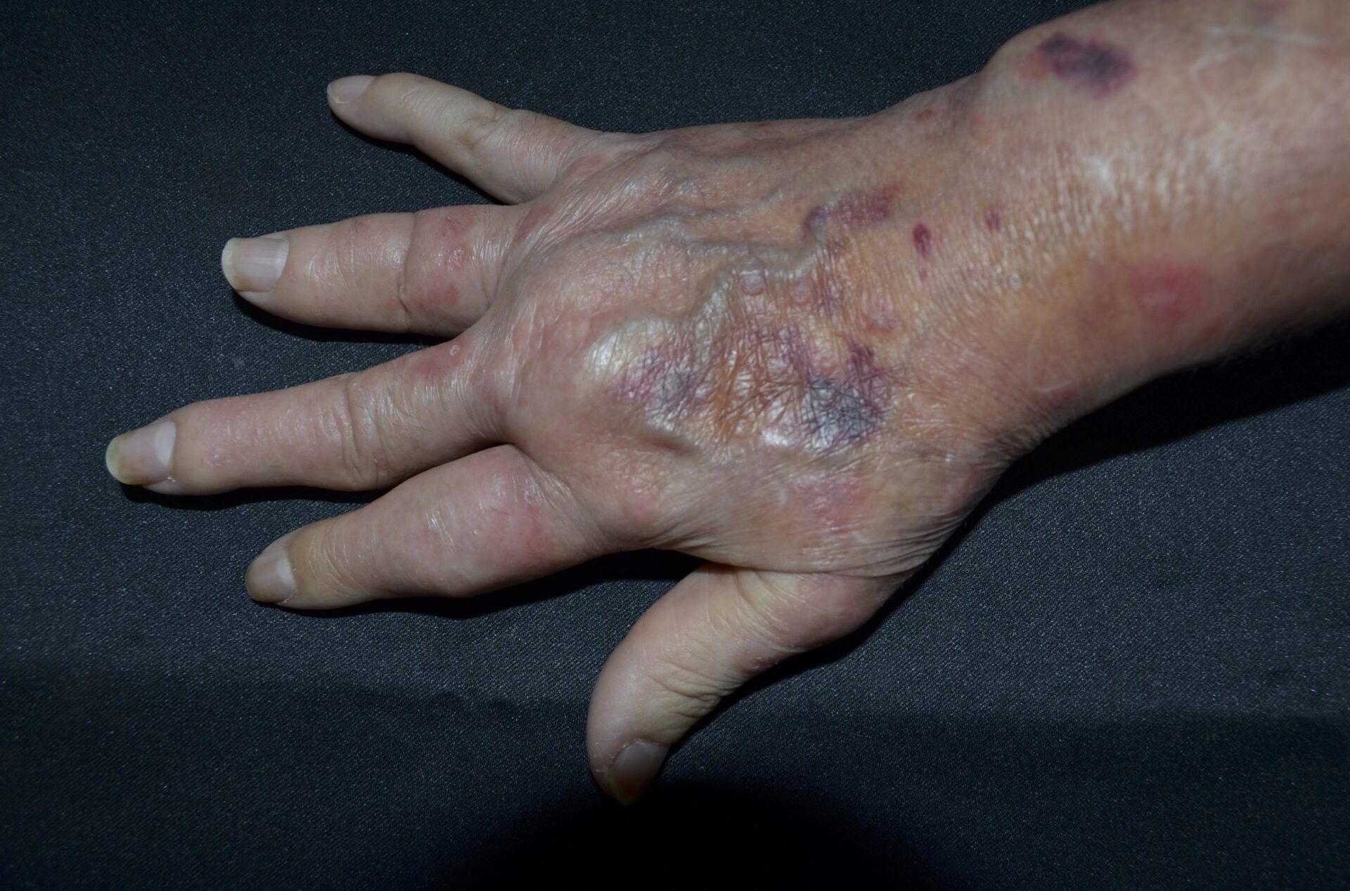 グルテンフリーの食事は役立つでしょうか?